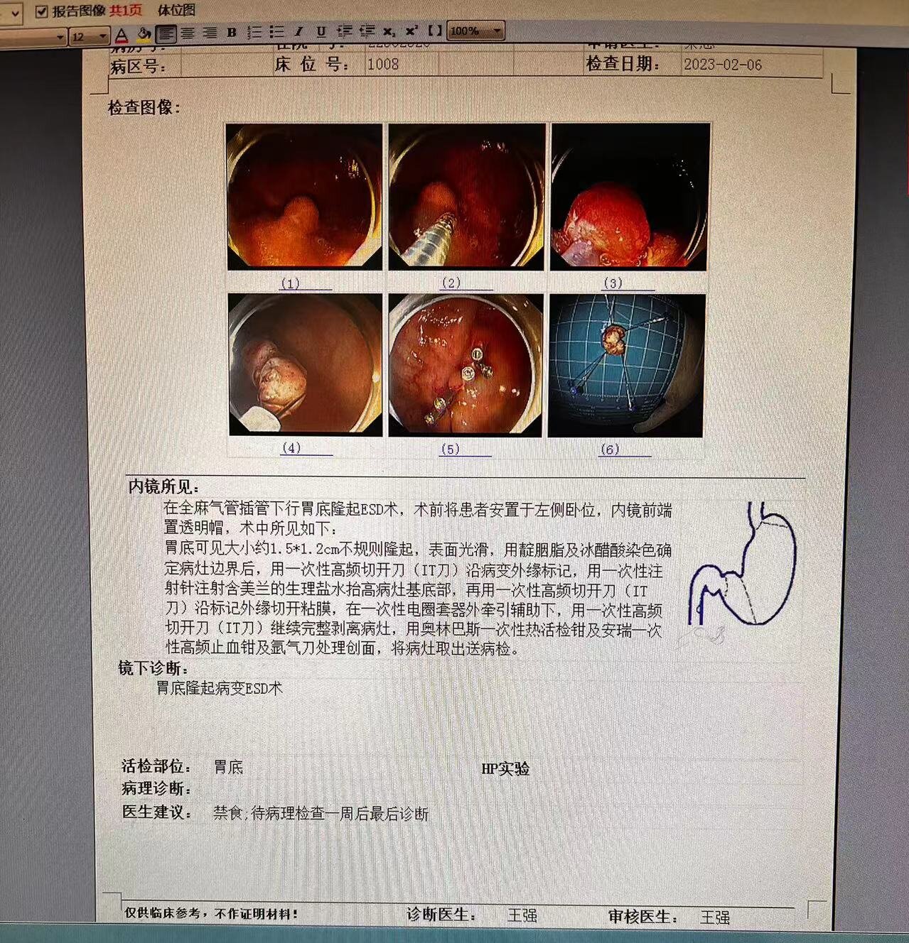 内镜下食管支架置入 解除梗阻立竿见影_技术前沿_科研教学_科研教学_华中科技大学协和江北医院|武汉蔡甸区人民医院